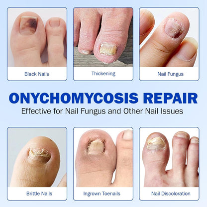 Curotron - Fungal Nail Renewal Patches